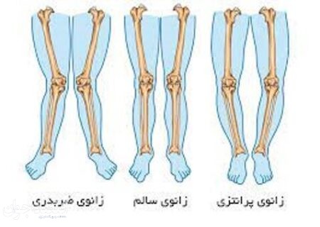 درمان ورزشی پای پرانتزی بزرگسالان!