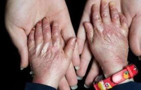 هزینه‌های سرسام‌آور و محدودیت دسترسی به دارو، زندگی بیماران نادر را سخت‌تر کرده است