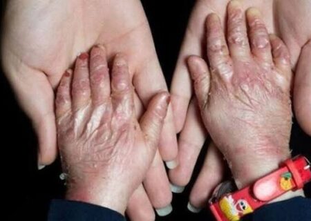 هزینه‌های سرسام‌آور و محدودیت دسترسی به دارو، زندگی بیماران نادر را سخت‌تر کرده است